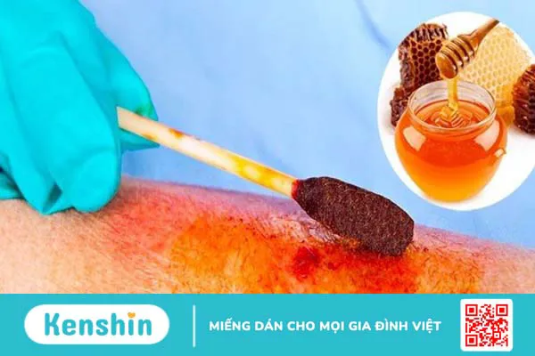 Bị bỏng nên làm gì? 12 mẹo trị phỏng nước sôi, bỏng lửa hiệu quả