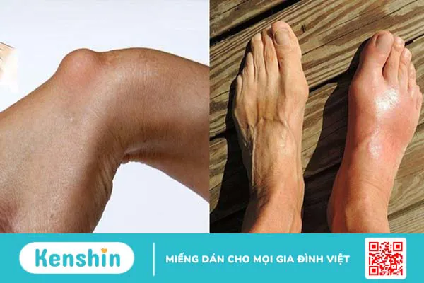 Bị đau gót chân là bệnh gì? 12 nguyên nhân đau gót chân bạn không thể bỏ qua