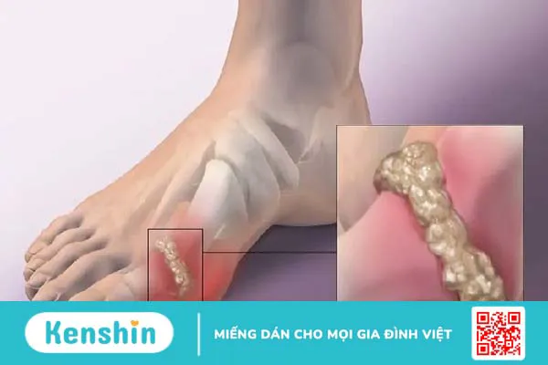 Bị gút kiêng ăn gì và nên ăn gì? Lưu ngay các loại thực phẩm sau