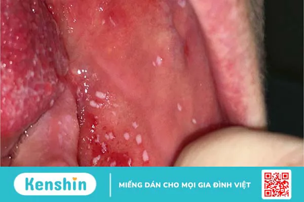 Bị sởi làm gì cho nhanh khỏi? Hướng dẫn điều trị sởi tại nhà hiệu quả