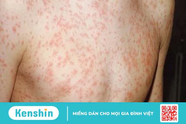 Bị sởi làm gì cho nhanh khỏi? Hướng dẫn điều trị sởi tại nhà hiệu quả