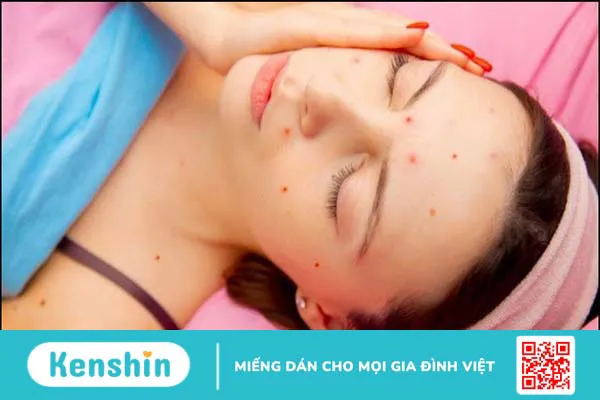 Bị thủy đậu kiêng gì? 5 thực phẩm cần tránh và lưu ý khi bị thủy đậu