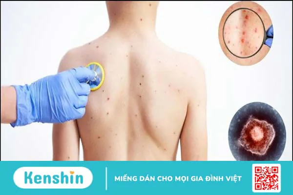 Bị thủy đậu kiêng gì? 5 thực phẩm cần tránh và lưu ý khi bị thủy đậu