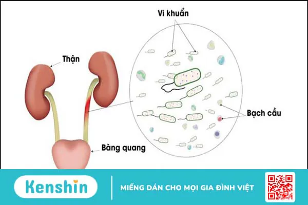 Bị viêm đường tiết niệu có quan hệ được không? Rủi ro, lưu ý cần biết