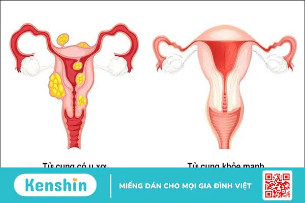 Biến chứng sau khi mổ u xơ tử cung là gì? 9 biến chứng có thể gặp