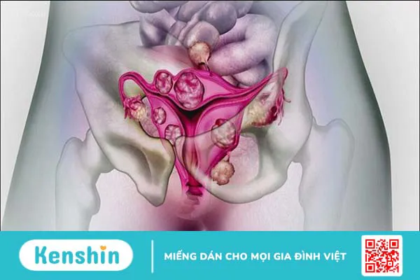 Biến chứng sau khi mổ u xơ tử cung là gì? 9 biến chứng có thể gặp