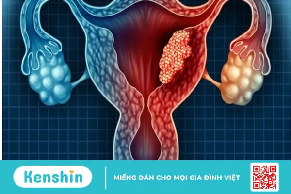 Biến chứng sau khi mổ u xơ tử cung là gì? 9 biến chứng có thể gặp