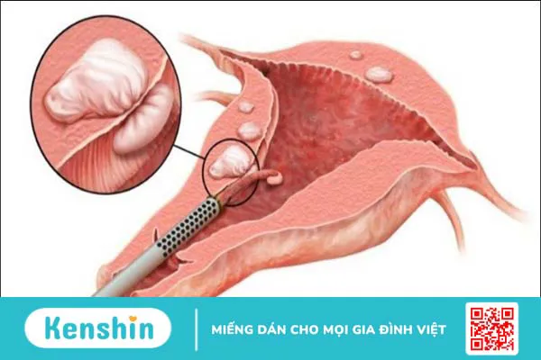 Biến chứng sau khi mổ u xơ tử cung là gì? 9 biến chứng có thể gặp