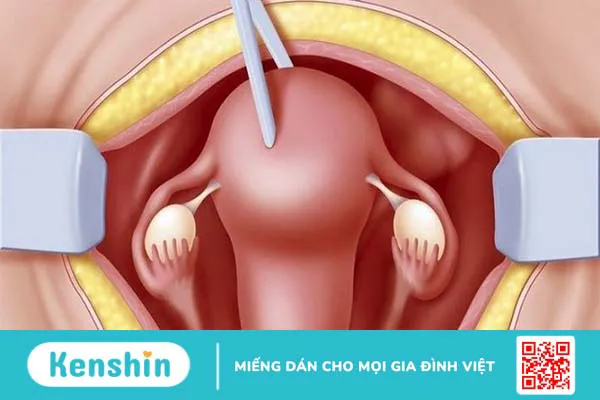 Biến chứng sau khi mổ u xơ tử cung là gì? 9 biến chứng có thể gặp