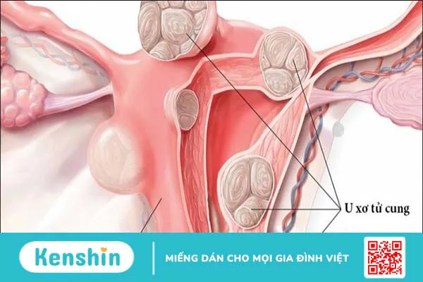 Biến chứng sau khi mổ u xơ tử cung là gì? 9 biến chứng có thể gặp