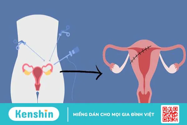 Biến chứng sau khi mổ u xơ tử cung là gì? 9 biến chứng có thể gặp