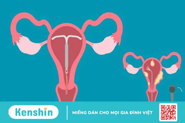 Biến chứng sau khi mổ u xơ tử cung là gì? 9 biến chứng có thể gặp