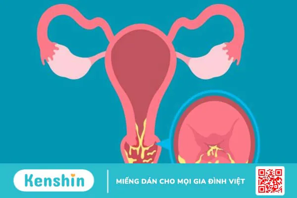 Biến chứng sau khi mổ u xơ tử cung là gì? 9 biến chứng có thể gặp