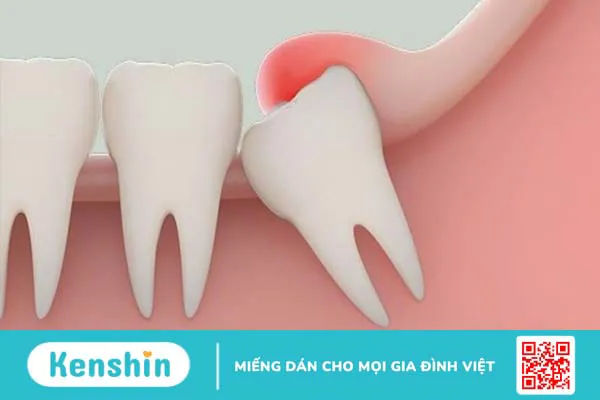 Biến chứng sau nhổ răng có thể gặp phải và cách chăm sóc sau nhổ răng