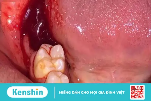 Biến chứng sau nhổ răng có thể gặp phải và cách chăm sóc sau nhổ răng