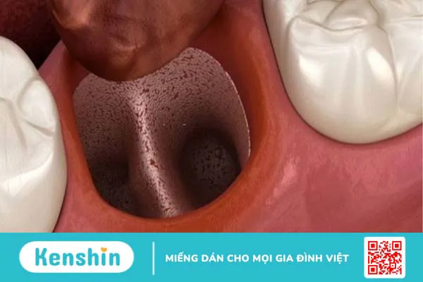 Biến chứng sau nhổ răng có thể gặp phải và cách chăm sóc sau nhổ răng