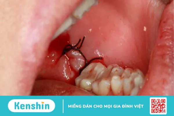 Biến chứng sau nhổ răng có thể gặp phải và cách chăm sóc sau nhổ răng