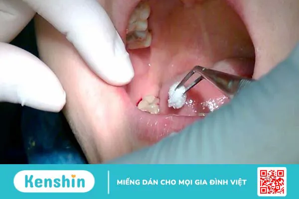 Biến chứng sau nhổ răng có thể gặp phải và cách chăm sóc sau nhổ răng