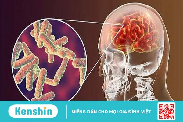 Biến chứng thần kinh hậu Covid-19