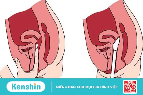 Biện pháp tránh thai mới, thuốc diệt tinh trùng liệu có hiệu quả không?