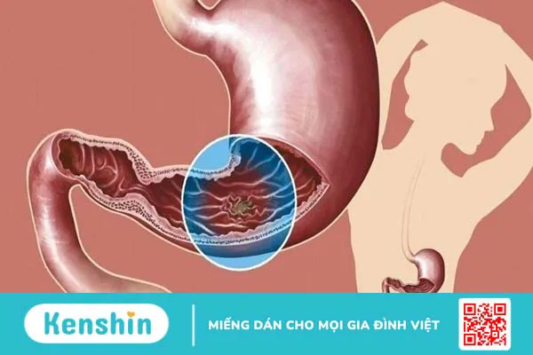 Bồ công anh có thể trị đau dạ dày không?