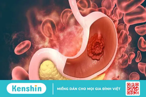 Bồ công anh có thể trị đau dạ dày không?