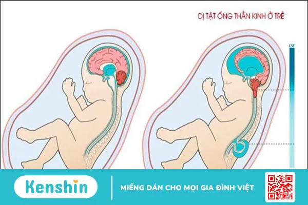 Bổ sung acid folic cho bà bầu khi mang thai, liều lượng và cách dùng