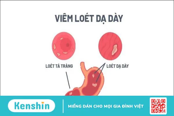 Các bệnh đường tiêu hóa thường gặp vào ngày lễ và cách phòng ngừa