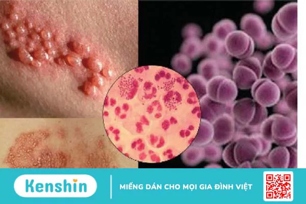 Các bệnh lây qua đường tình dục – 11 bệnh phổ biến cần cảnh báo