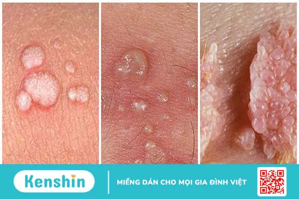 Các bệnh lây qua đường tình dục – 11 bệnh phổ biến cần cảnh báo