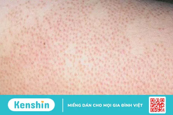 Các bệnh thường gặp khi thường xuyên tắm mưa và lưu ý sau khi tắm mưa