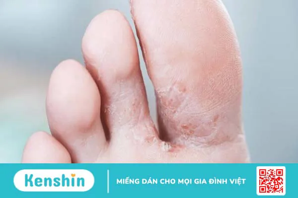 Các bệnh thường gặp khi thường xuyên tắm mưa và lưu ý sau khi tắm mưa