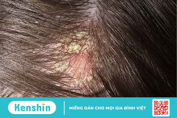 Các bệnh thường gặp khi thường xuyên tắm mưa và lưu ý sau khi tắm mưa