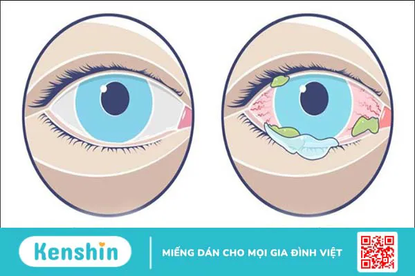 Các bệnh thường gặp vào mùa mưa và cách phòng tránh hiệu quả