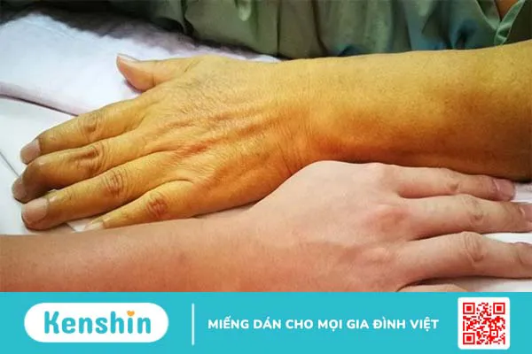 Các bệnh thường gặp vào mùa mưa và cách phòng tránh hiệu quả