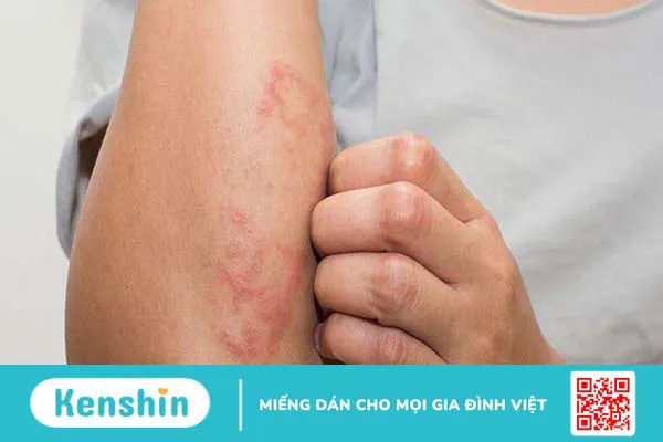 Các bệnh thường gặp vào mùa mưa và cách phòng tránh hiệu quả