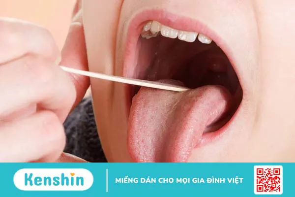 Các biến chứng viêm họng hạt bạn cần chú ý