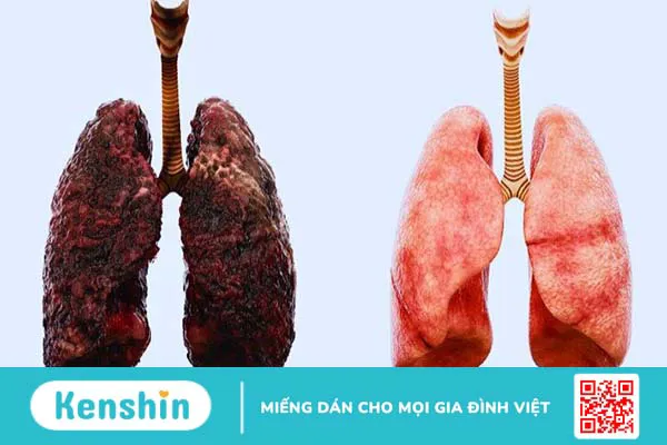 Các biện pháp phòng chống bệnh lao phổi và những điều cần lưu ý