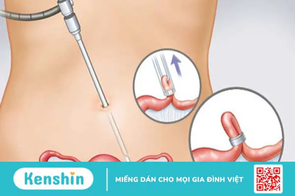 Các biện pháp tránh thai an toàn và hiệu quả nhất hiện nay