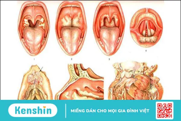 Các cách chăm sóc trẻ bệnh bạch hầu bố mẹ nên biết và cách phòng ngừa