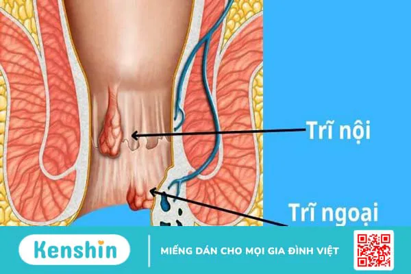 Các cách chữa bệnh trĩ tận gốc hiệu quả đơn giản và an toàn nhất