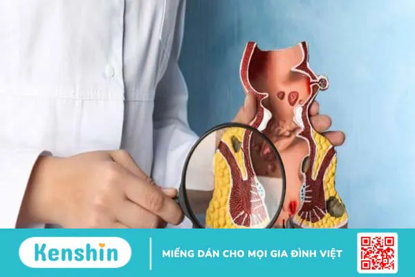 Các cách chữa bệnh trĩ tận gốc hiệu quả đơn giản và an toàn nhất