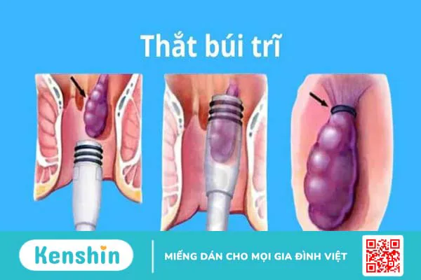 Các cách chữa bệnh trĩ tận gốc hiệu quả đơn giản và an toàn nhất