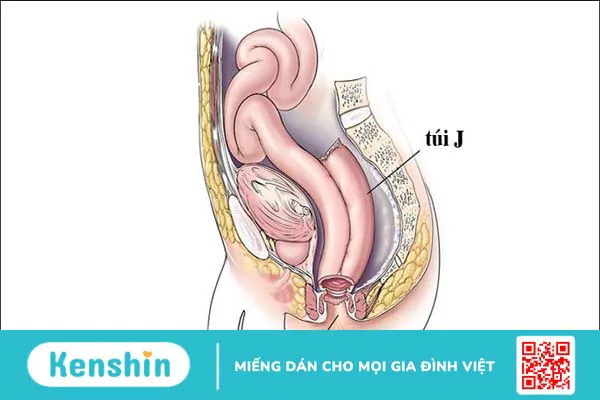 Các cách điều trị và phòng ngừa viêm loét đại tràng