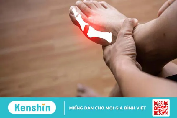 Các dấu hiệu nhận biết sớm của bệnh gout để điều trị hiệu quả