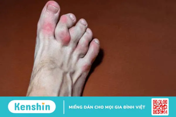 Các dấu hiệu nhận biết sớm của bệnh gout để điều trị hiệu quả