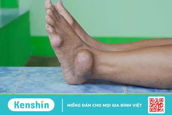 Các dấu hiệu nhận biết sớm của bệnh gout để điều trị hiệu quả