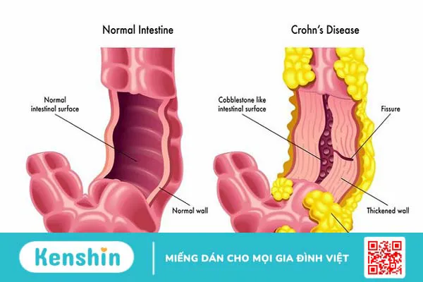 Các nguyên nhân gây tiêu chảy kéo dài bạn cần biết