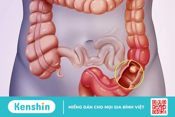 Các nguyên nhân gây tiêu chảy kéo dài bạn cần biết