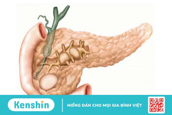 Các nguyên nhân gây tiêu chảy kéo dài bạn cần biết